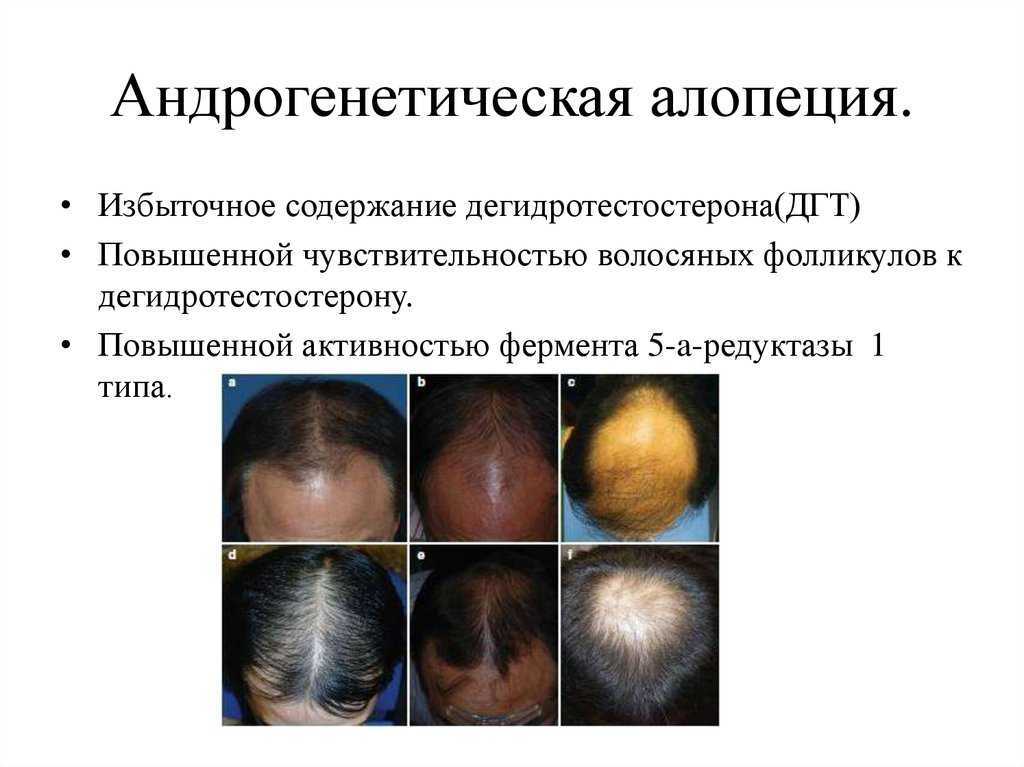 Сильное выпадение волос у женщин: причины, что делать?