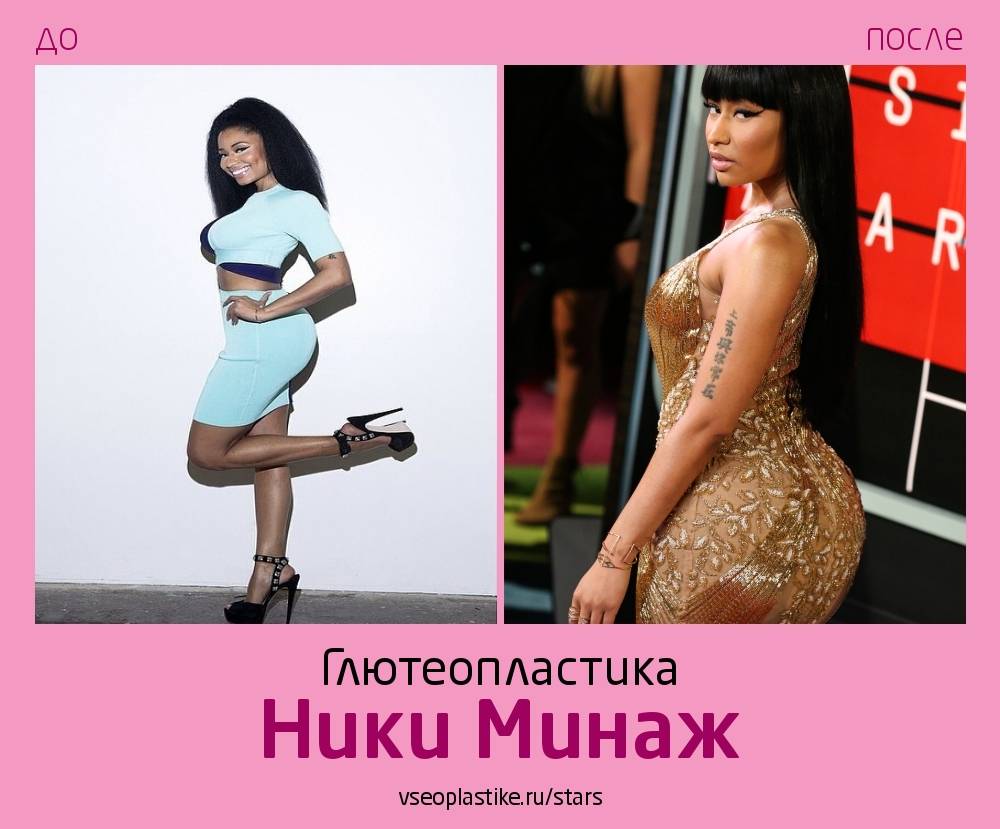Ники минаж до операции. ники минаж: операция на ягодицы (фото до и после)