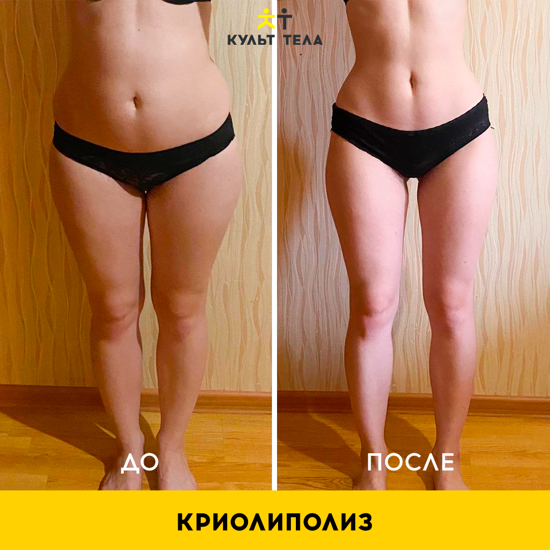 Что такое криолиполиз (криолипосакция)