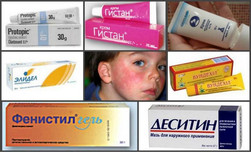Мазь от аллергии на лице: какая помогает и чем мазать, противоаллергические средства для взрослых, не гормональный крем для кожи