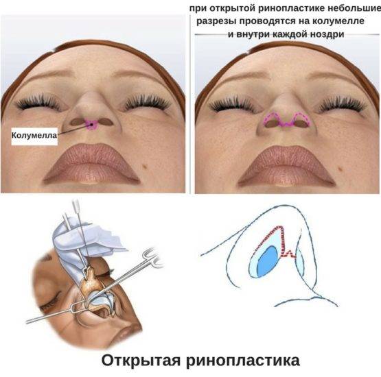 Безоперационная ринопластика носа: виды, как делают и уход после