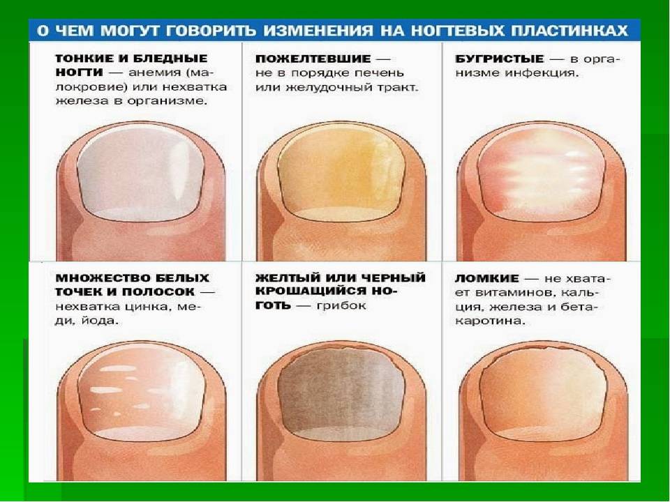 Белые пятна на ногтях приметы. цветут ногти на руках что это значит цветение ногтей причины