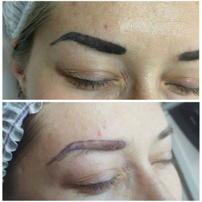 Как убрать татуаж бровей: 8 способов избавиться даже от самого старого татуажа