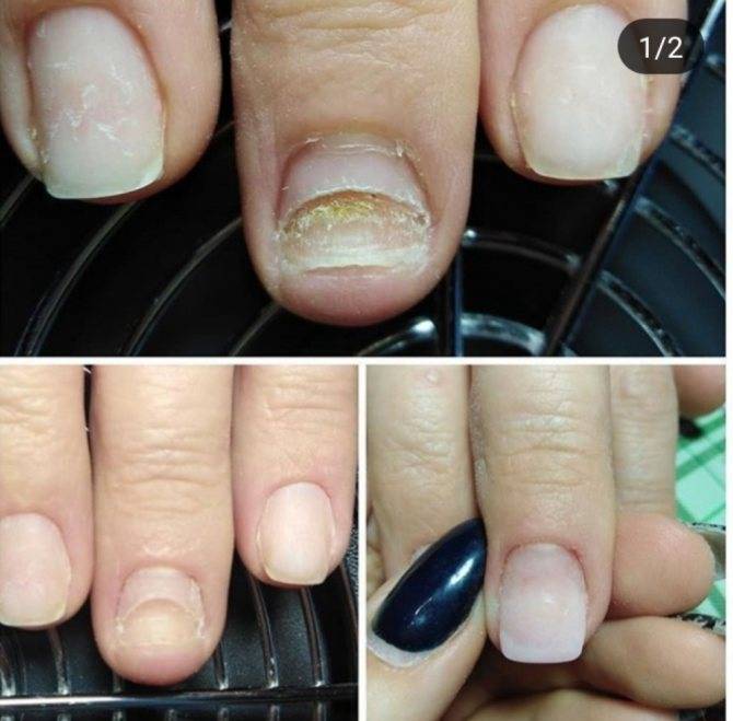 Что такое онихолизис ногтей?
