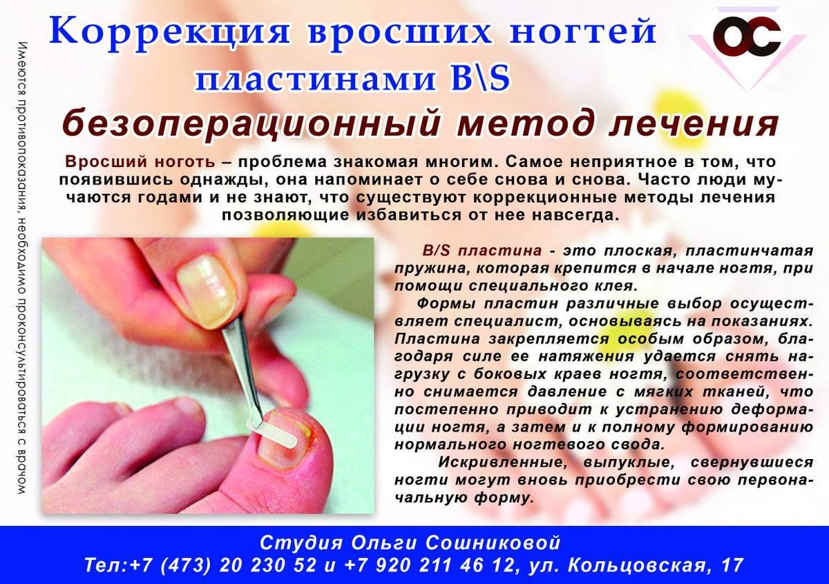Ноготь после удаления – уход и заживление -