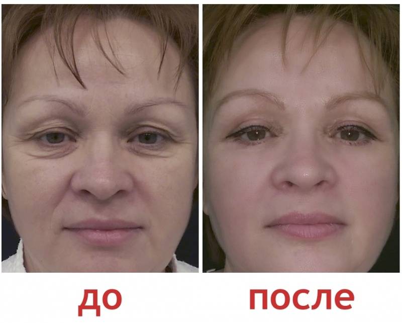 Блефаропластика: отзывы прооперированных, фото до и после, что это такое, стоимость на подтяжку век хирургическим путем, как проходит операция под местной анестезией