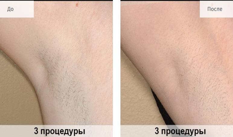 Лазерная эпиляция глубокого бикини