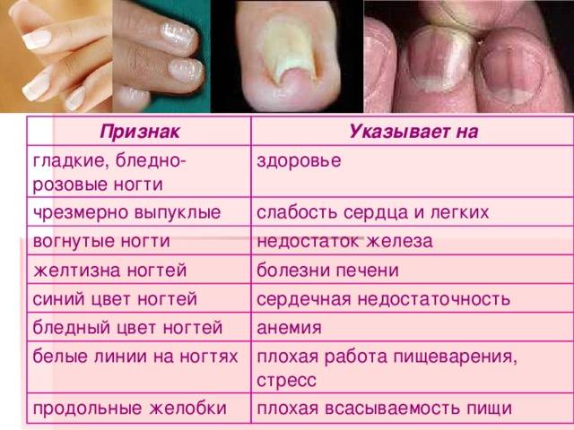Почему появляются продольные полосы на ногтях