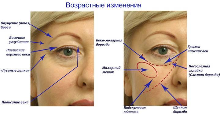 Как убрать малярные мешки под глазами: топ-7 способов