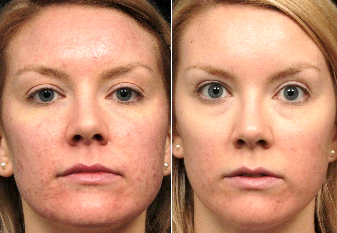 Какая процедура дает лучший эффект: лазерное или фотоомоложение