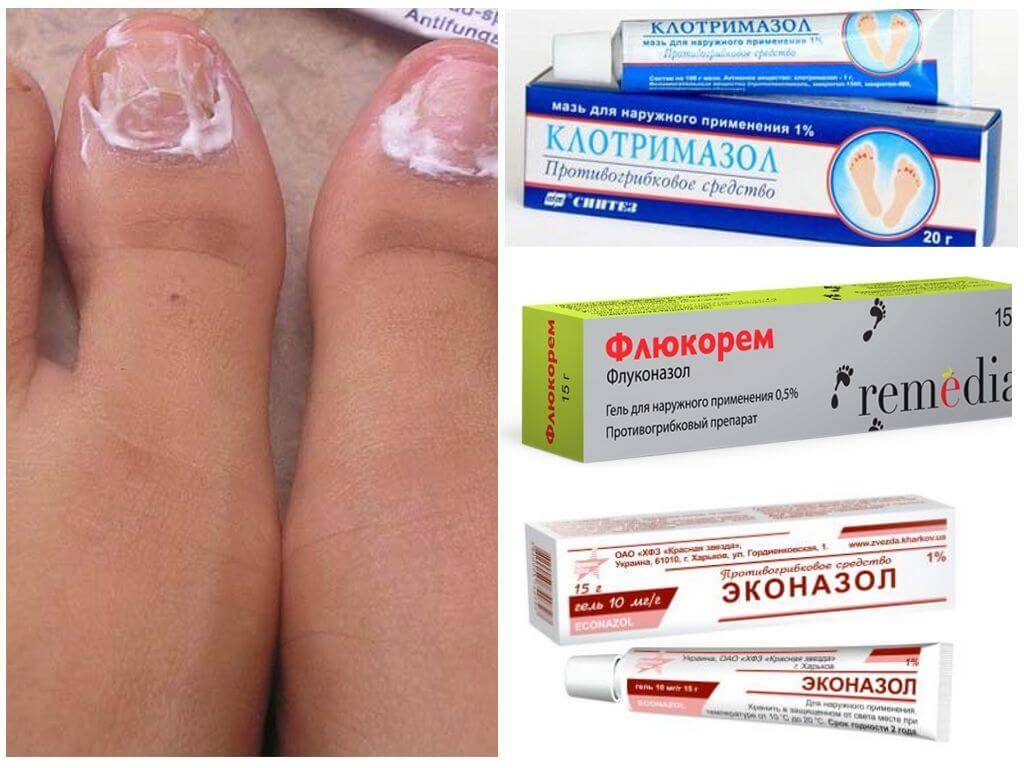 Топ-15 препаратов от грибка на ногтях