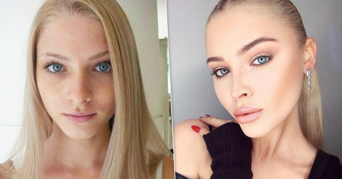 Алёна шишкова фото до и после пластики – скачать бесплатно