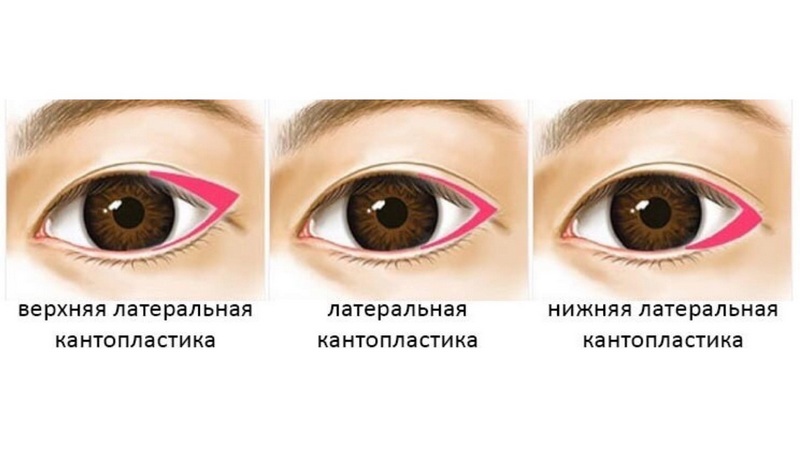 Что такое кантопексия. для чего проводится кантопексия. омоложение глаз методом пластической хирургии