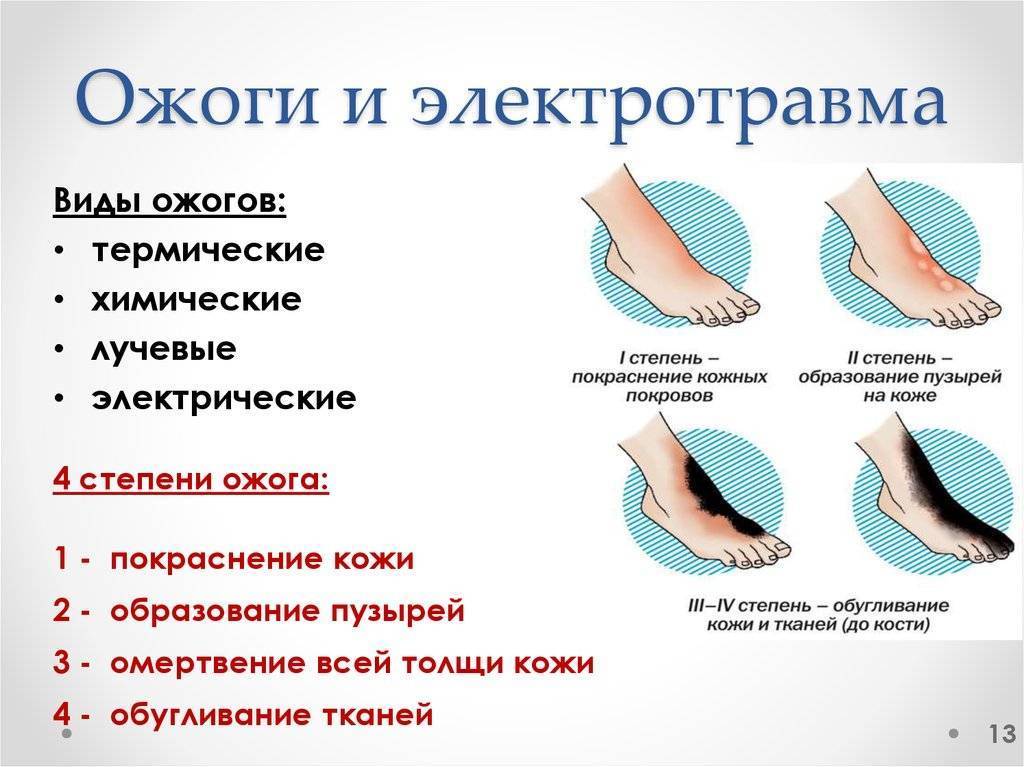 Первая помощь при легких ожогах . что делать пострадавшим?