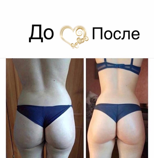 Как убрать складку под ягодицами упражнения