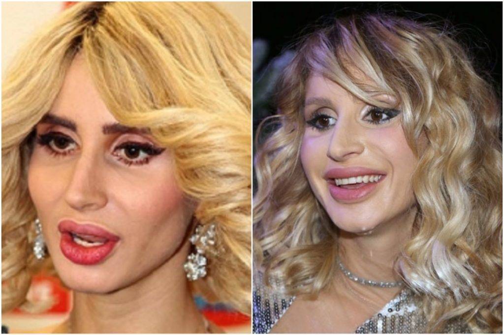 Фото российских знаменитостей и голливудских звезд до и после пластики | qulady