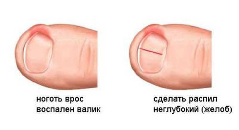 Как избавиться от вросших ногтей