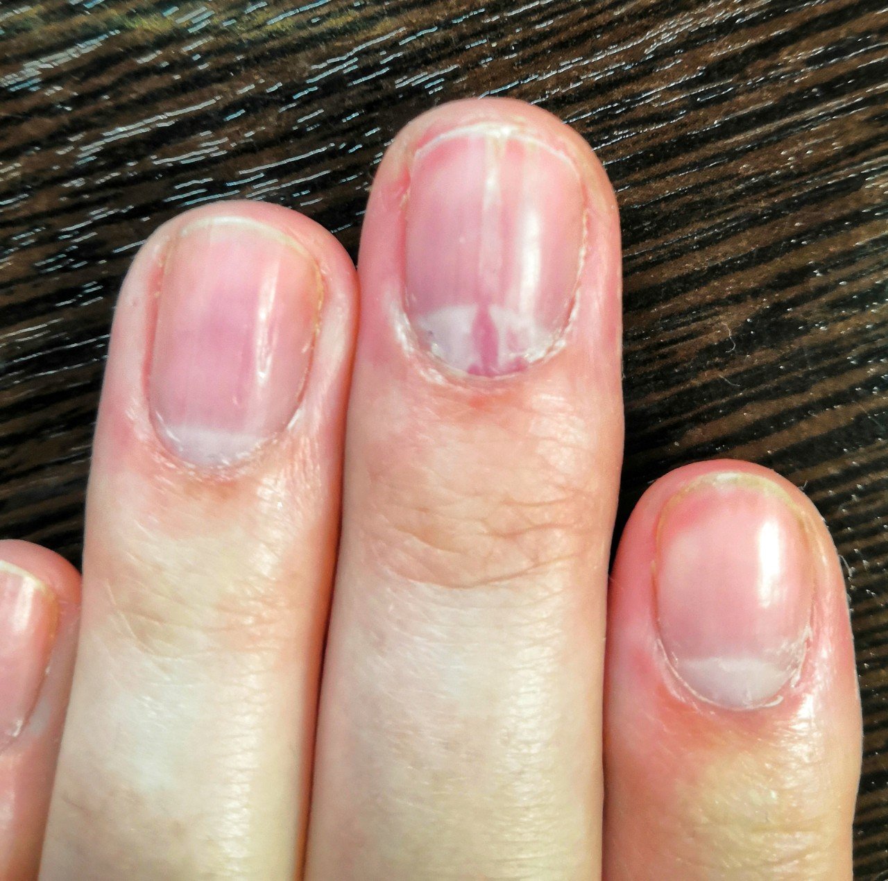 Ушиб ногтя на руке или ноге: что делать и как лечить в домашних условиях