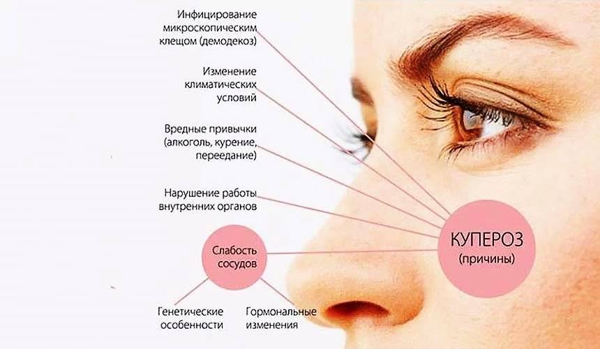 Лечение купероза на лице: салонные процедуры и народные средства