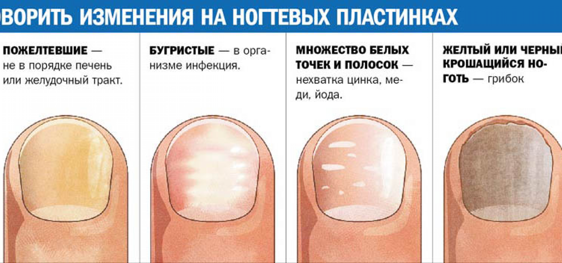 Грибок ногтей (онихомикоз)