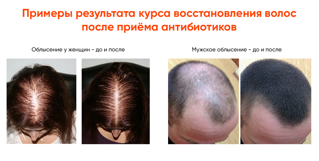 Облысение
