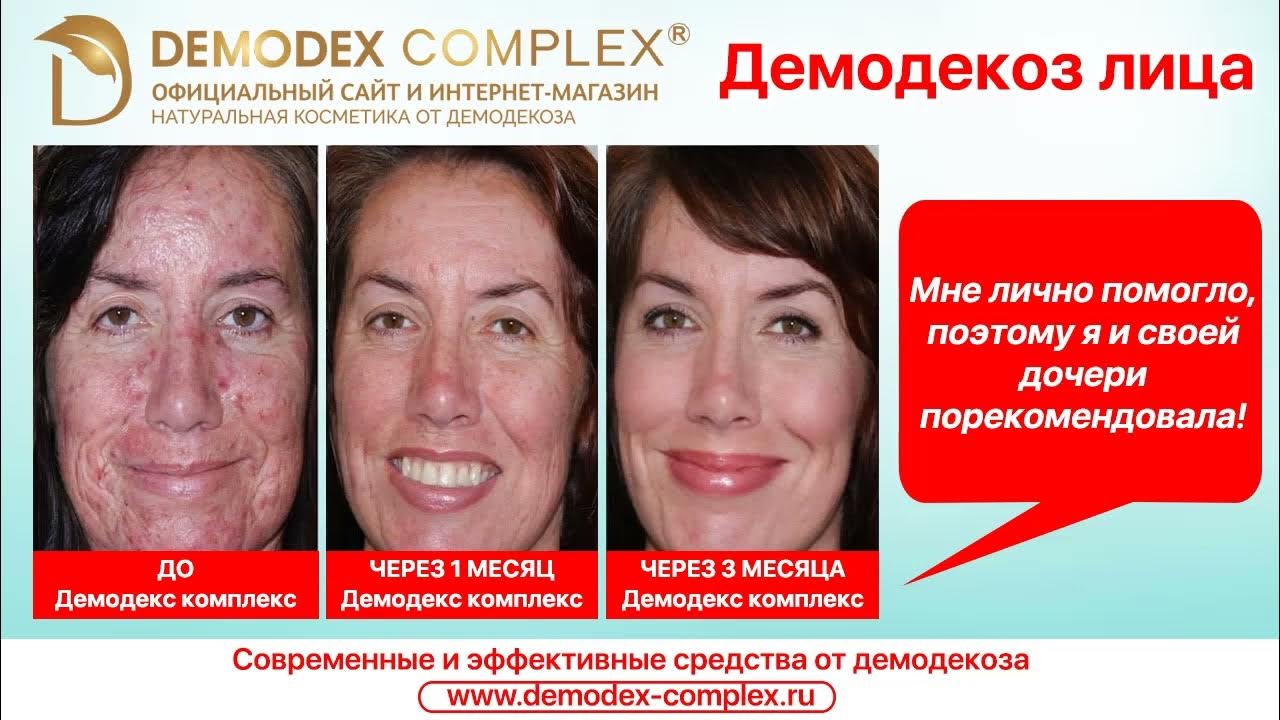 Клещ демодекс - причина демодекоза