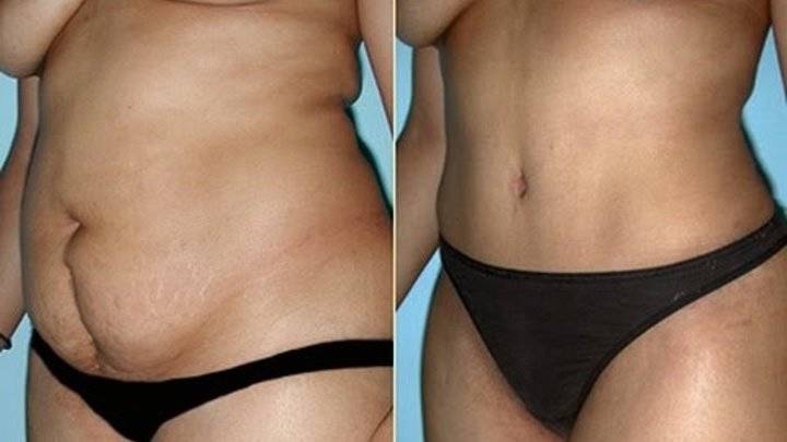Как подтянуть кожу после похудения (лучшие методы)?