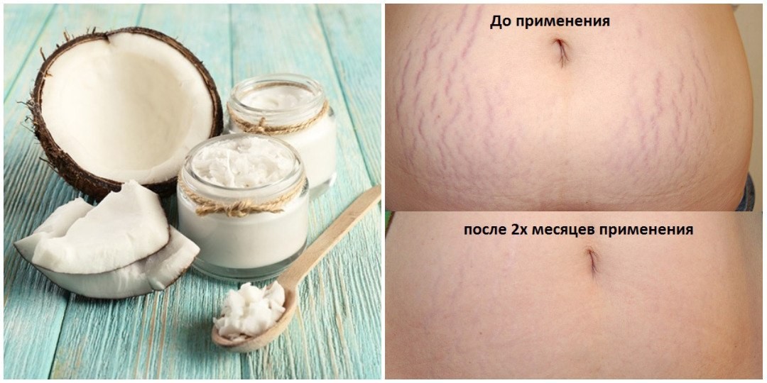 Как избавиться от растяжек на груди - средства, методы, упражнения