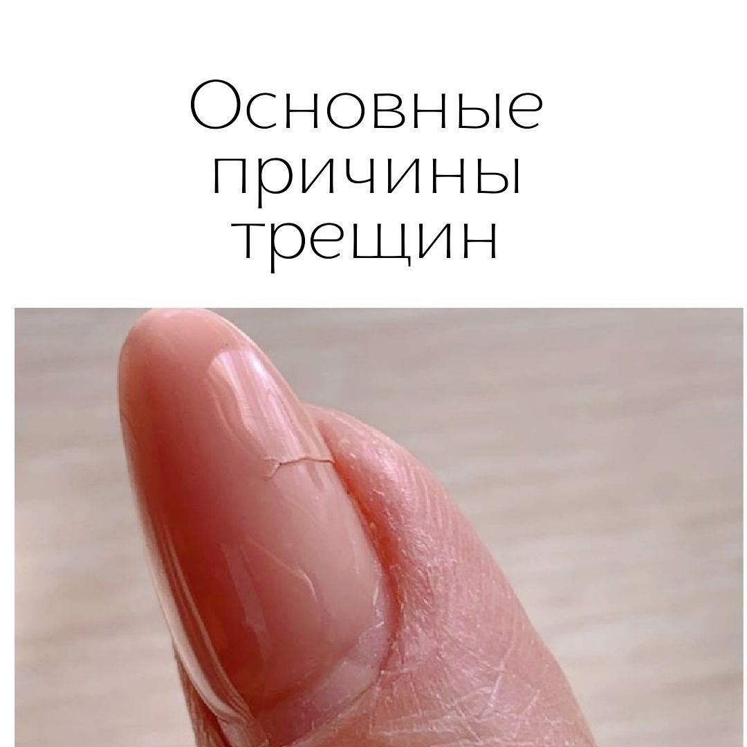 Трещины на пальцах рук возле ногтей: причины, факторы, болезни и лечение