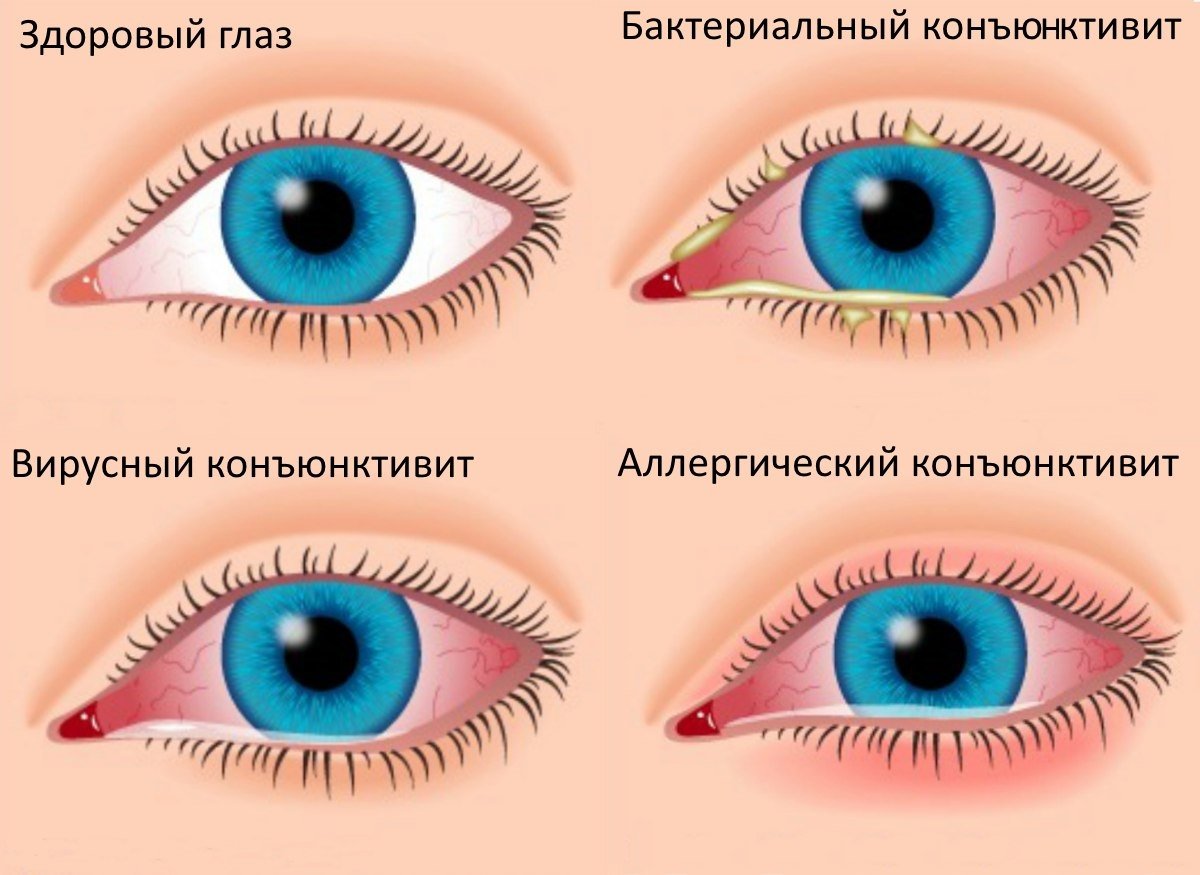 Покраснение век, повышенное слезотечение, появление выделений из глаз у детей: причины, осложнения, лечение и диагностика