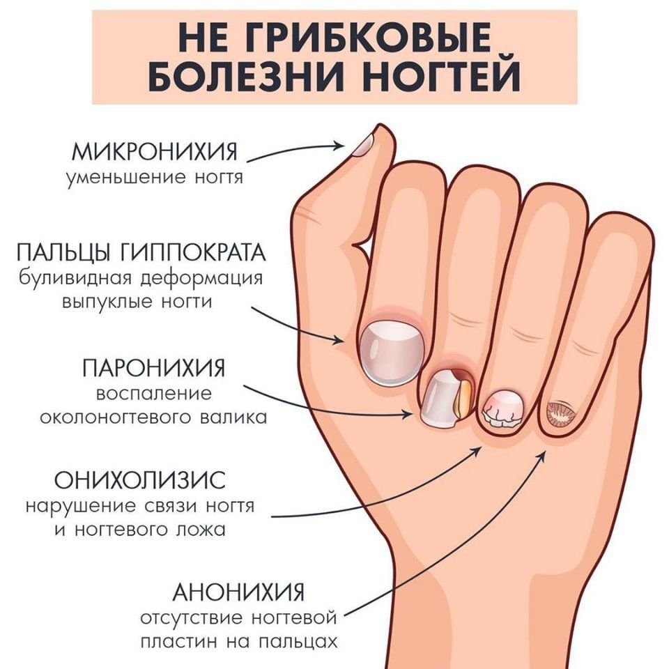 Почему чернеют ногти на ногах