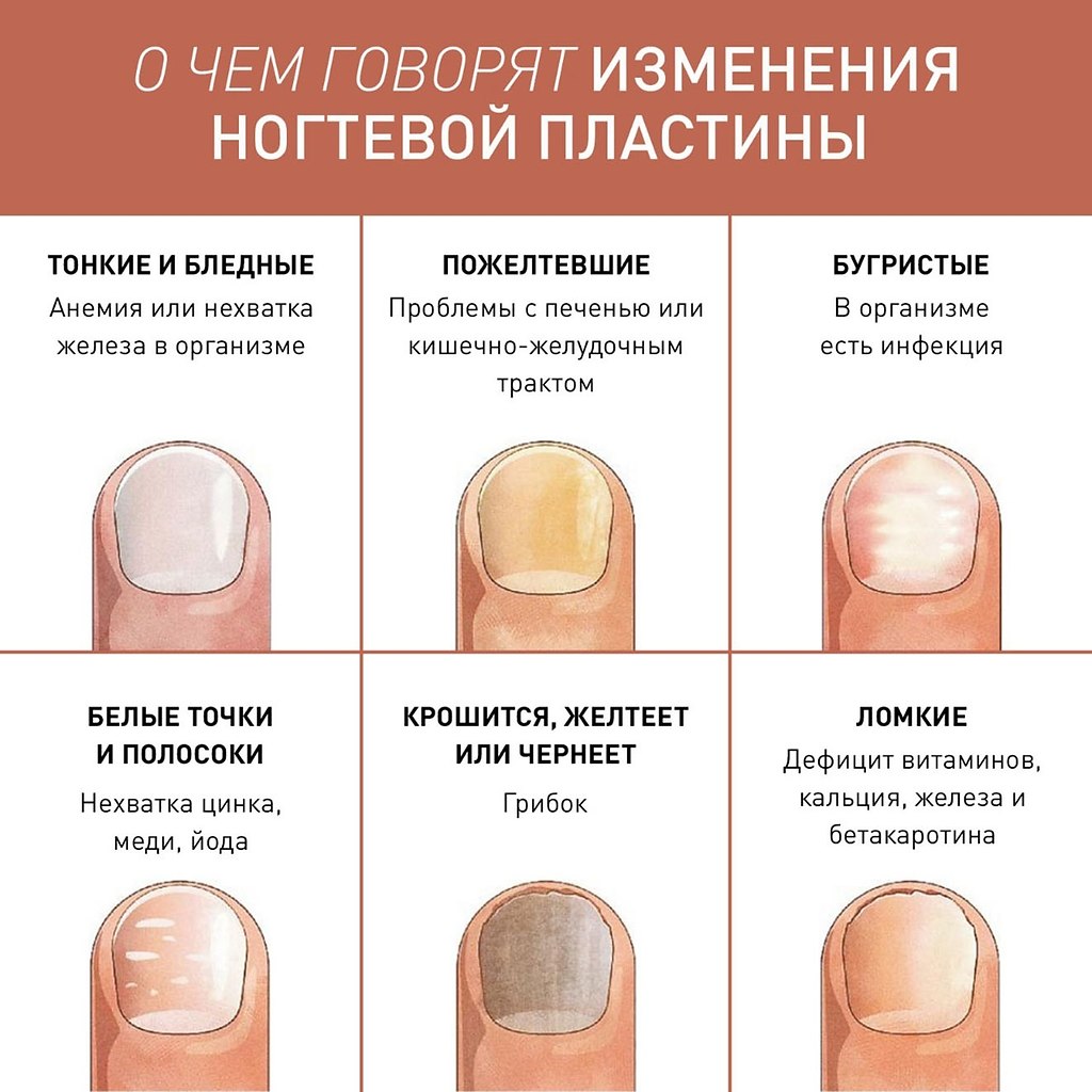 Ремонт ногтя гель-лаком. ремонт трещины и скола