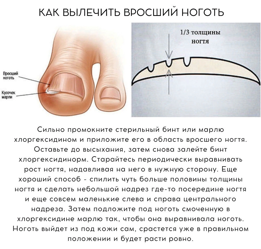 Что делать, если у новорожденного вросший ноготь на пальце?