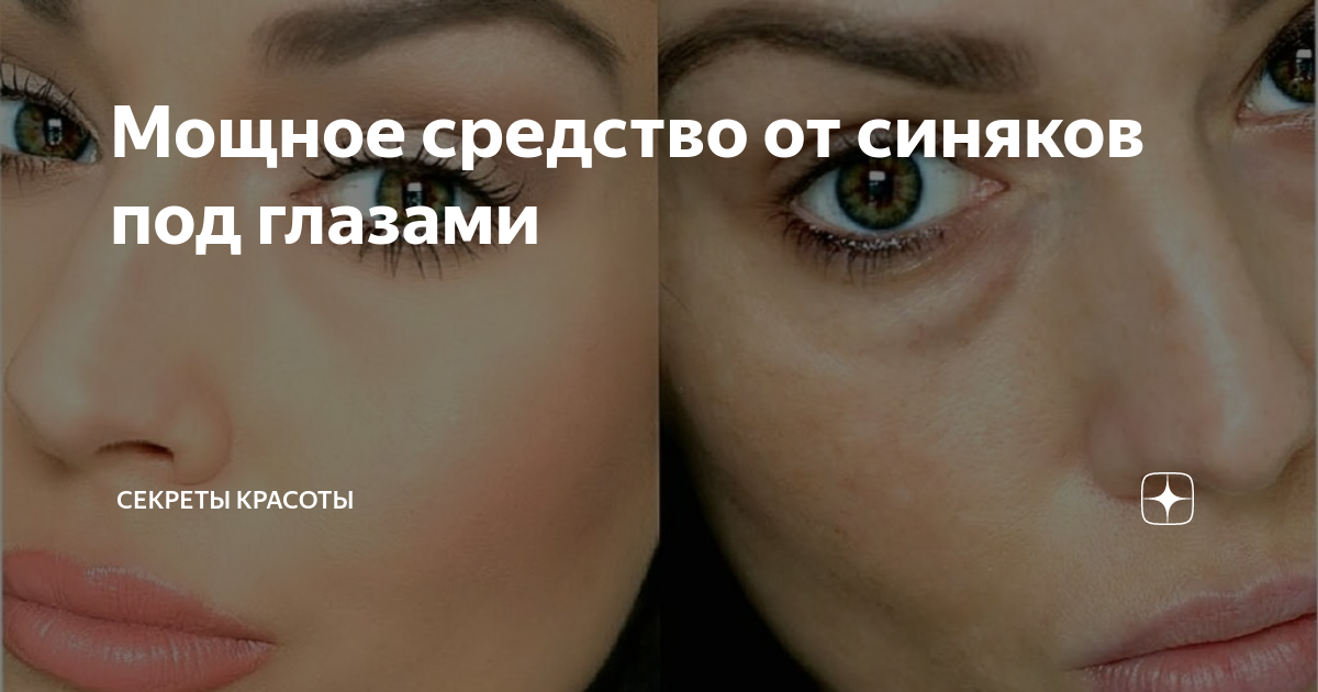 Как быстро убрать синяк под глазом