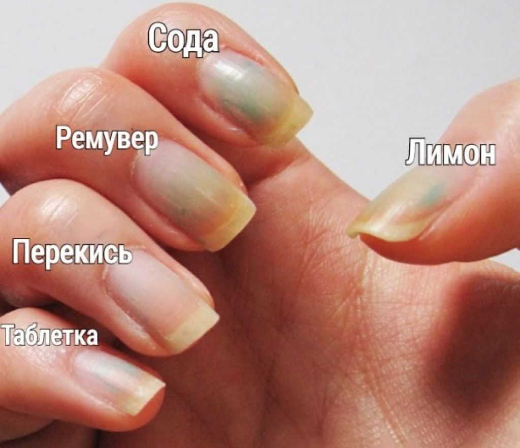 Почему желтеют ногти на руках и ногах: лечение, причины | азбука здоровья