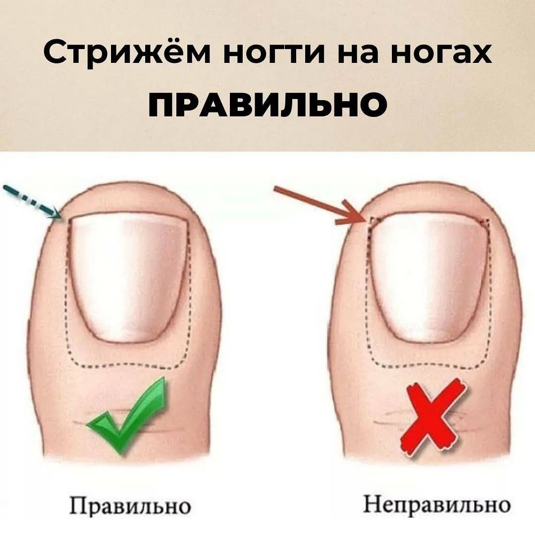 Удаление ногтевой пластины: необходимая подготовка, ход приема и противопоказания | услуги клиники «проксима» (г. сочи)