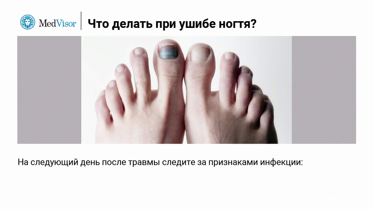 Лечение травмы ногтя: советы медиков | красивые ногти - дополнение твоего образа