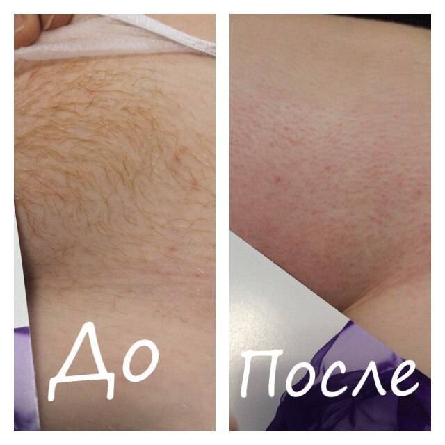Сахарная эпиляция зоны глубокого бикини в салоне и домашних условиях