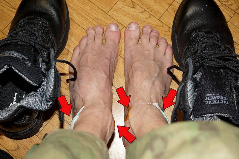 Ботинки натирают пятку: что делать