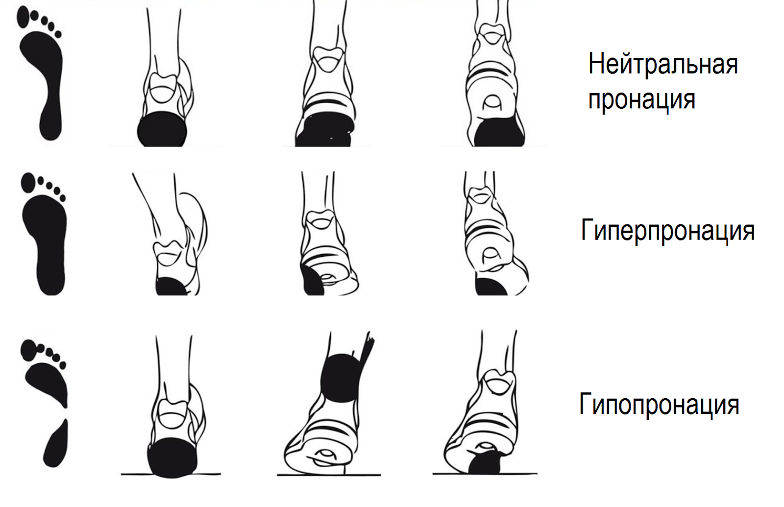 Что такое пронация в кроссовках
