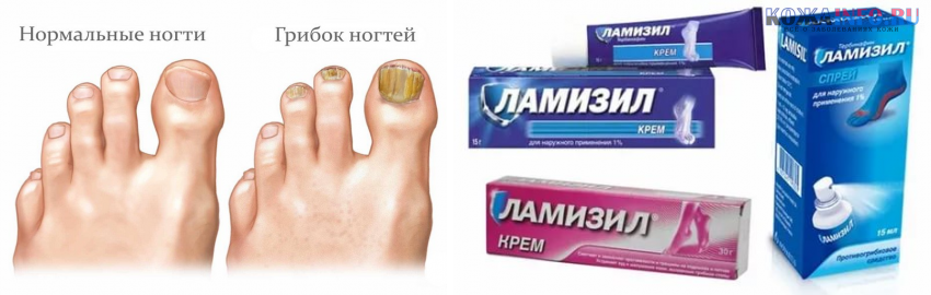Кремы для лечения грибка ногтей