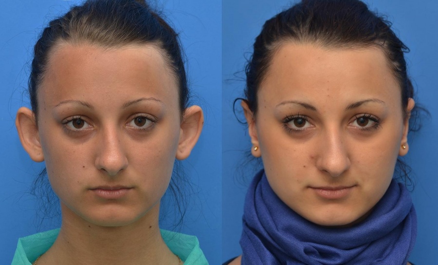 Нитевая отопластика (коррекция ушных раковин) - estetik international | aesthetic plastic surgery estetik international | aesthetic plastic surgery