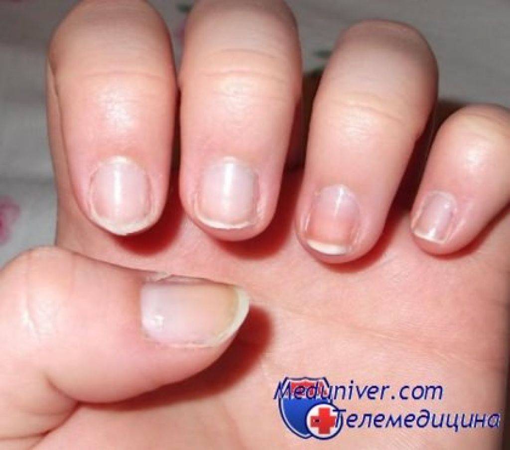 Заусенцы на пальцах: как избавиться от этих неприятностей?