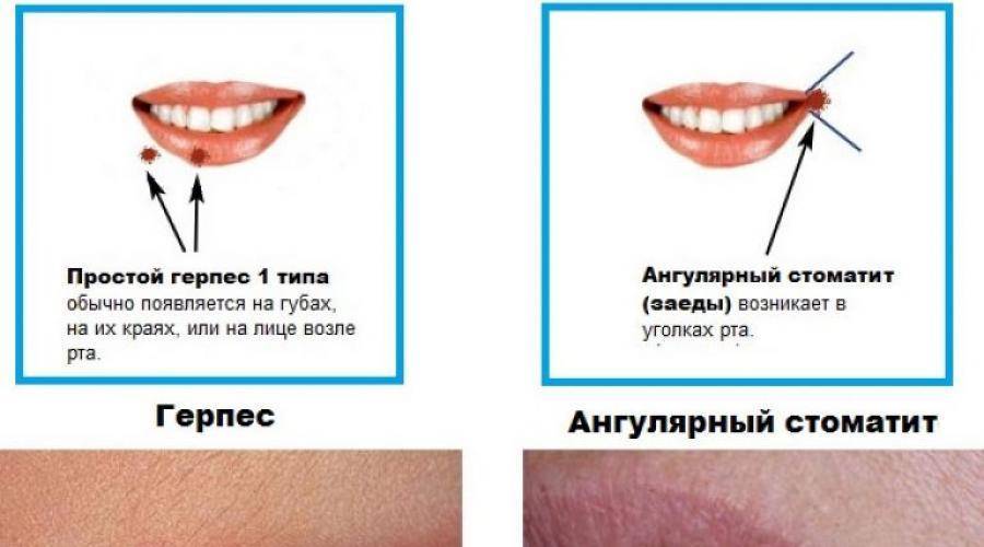 Трещины на губах — причины и лечение в домашних условиях