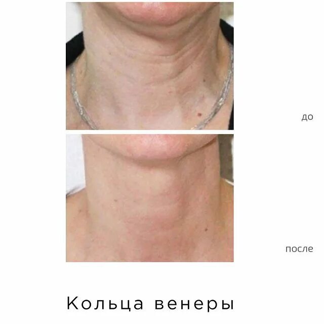 Как убрать «кольца» на шее: план действий