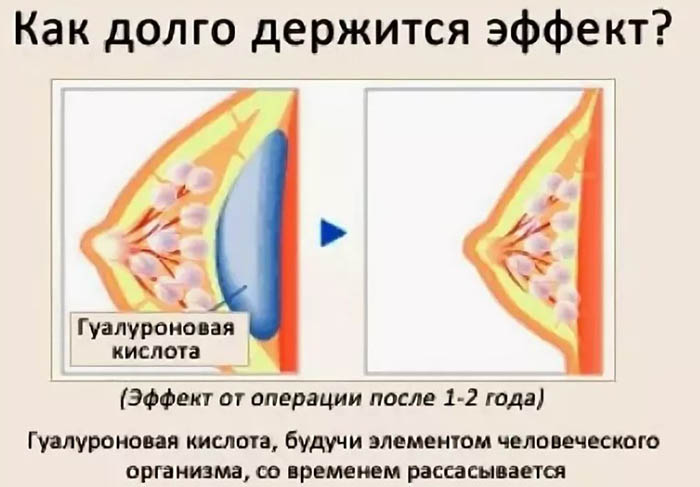 Радикальные и безоперационные способы увеличения груди