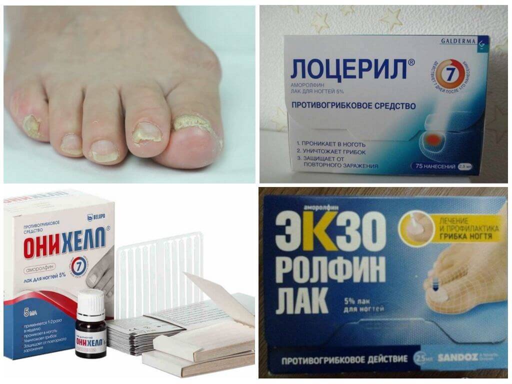 Как вылечить грибок ногтей, лекарства и народные средства