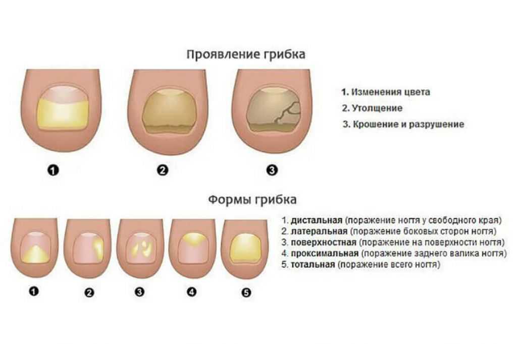Болезни ногтей с изменением цвета
