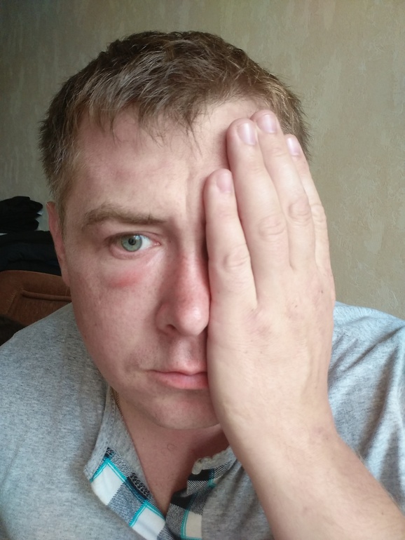 Причины появления мешков под левым глазом. что означают отеки под глазом