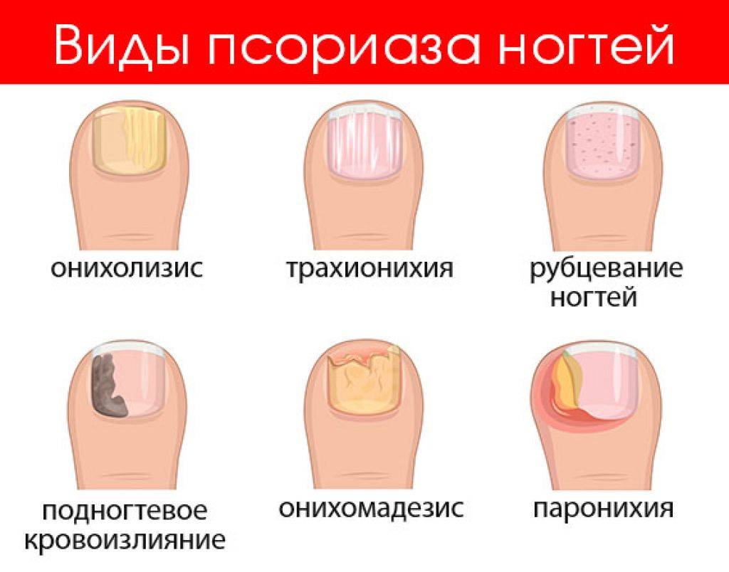 Пустота под ногтем на руке